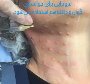 جوانسازی گردن و دکلته - قبل از درمان