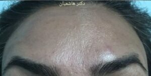 بوتاکس پیشانی - بعد از درمان