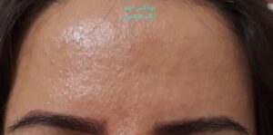 بوتاکس خط اخم - بعد از درمان