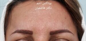 بوتاکس خط اخم - بعد از درمان