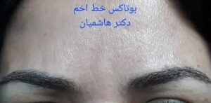 بوتاکس خط اخم - بعد از درمان