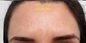 بوتاکس خط اخم - بعد از درمان