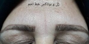 بوتاکس خط اخم - بعد از درمان