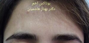 بوتاکس خط اخم - بعد از درمان