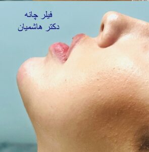 فیلر چانه - بعد از درمان