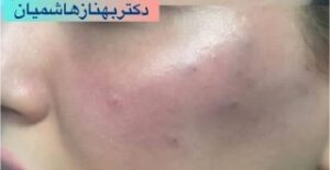 فیلر گونه - بعد از درمان
