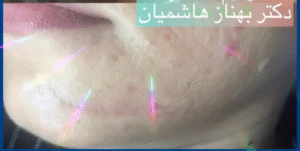 درمان اسکار - بعد از درمان