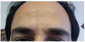 بوتاکس خط اخم - بعد از درمان