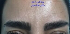 بوتاکس خط اخم - بعد از درمان