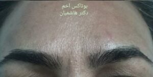 بوتاکس خط اخم - بعد از درمان