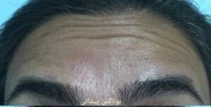 بوتاکس پیشانی - قبل از درمان