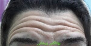 بوتاکس پیشانی - قبل از درمان