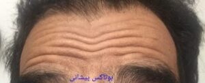 بوتاکس پیشانی - قبل از درمان