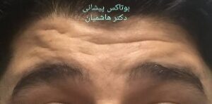 بوتاکس پیشانی - قبل از درمان