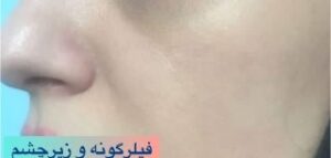 فیلر گونه - قبل از درمان