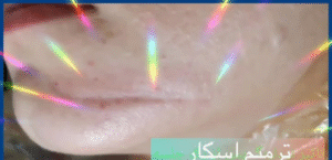 درمان اسکار - قبل از درمان