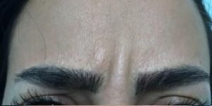 بوتاکس خط اخم - قبل از درمان