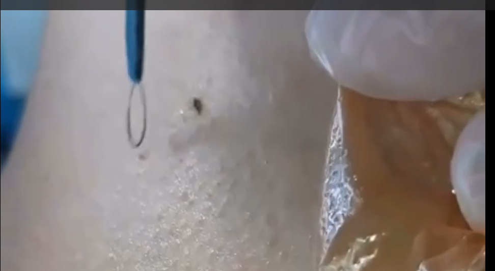 برداشت خال و زگیل