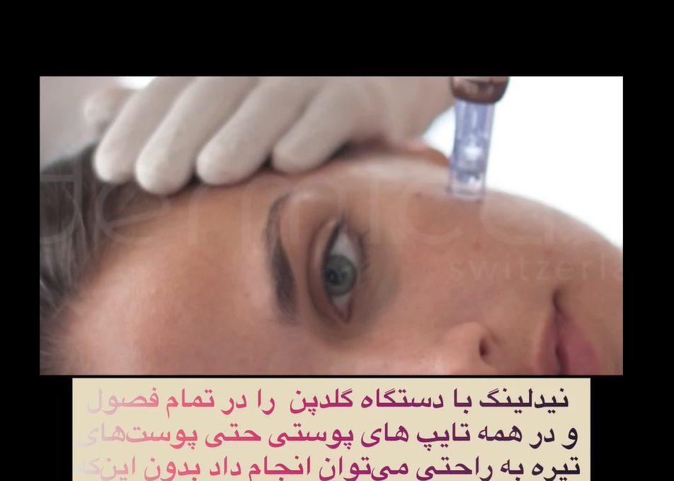 نیدلینگ با دستگاه گلدپن